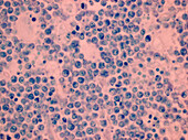 Burkitt's lymphoma, light micrograph