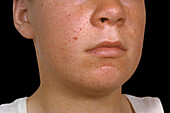 Skin lesions in tuberous sclerosis