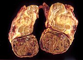 Neuroblastoma, gross specimen