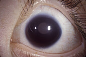 Absent iris