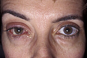 Blepharoconjunctivitis
