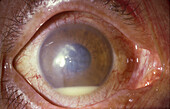 Corneal abscess and hypopyon