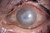 Corneal ulcer and abscess