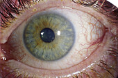 Adenovirus keratitis