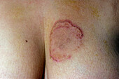 Lesions in fixed drug eruption