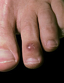 Myxoid pseudocyst