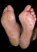 Plantar keratoderma