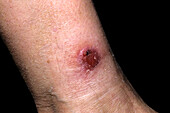 Cutaneous leishmaniasis lesion