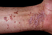 Lichen planus