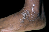Lichen planus