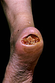 Heel ulcer in amyloid neuropathy