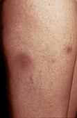 Weber-Christian disease
