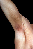 Parapsoriasis lichenoides in the armpit