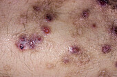 Prurigo lesions on a man's back