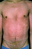 Erythrodermic psoriasis