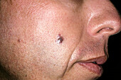 Kaposi's sarcoma on face of AIDS patient