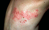 Shingles rash