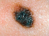 Superficial spreading melanoma