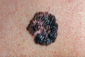 Superficial spreading melanoma