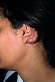 Keloid scar