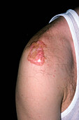 Keloid scar