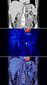 Secondary lymph node cancer, CT and PET scans