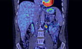 Secondary lymph node cancer, combined CT and PET scans