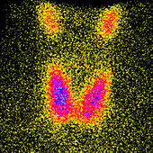 Thyroid gland, scintigram