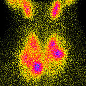Toxic multinodular goitre, scintigram