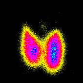 Graves' disease, scintigram