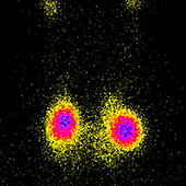 Toxic thyroid adenomas, scintigram