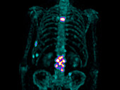 Secondary bone cancer of the spine, scintigram