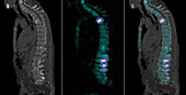 Secondary bone cancer of the spine, scintigram and CT scans