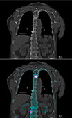 Secondary bone cancer of the spine, scintigram and CT scans