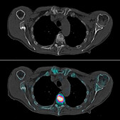 Secondary spinal cancer, scintigram and CT scans