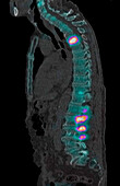 Secondary spinal cancer, composite scintigram and CT scan