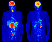 Diffuse large B-cell lymphoma, PET scans