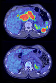 Diffuse large B-cell lymphoma, CT and PET scans
