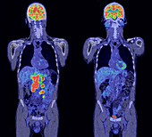 Diffuse large B-cell lymphoma, CT and PET scans