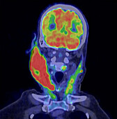 Diffuse large B-cell lymphoma, CT and PET scan
