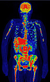 Metastatic breast cancer, PET scan