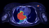 Diffuse large B-cell lymphoma, composite CT and PET scan