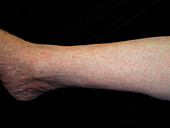 Pigmented purpuric dermatosis