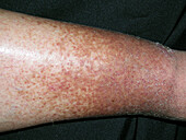 Pigmented purpuric dermatosis