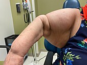 Lymphoedema