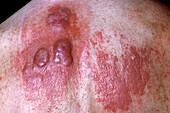 Mycosis fungoides