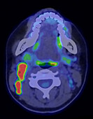 Hodgkin's disease, CT-PET scan