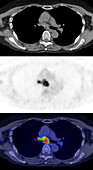 Non-Hodgkin lymphoma, CT and PET scans