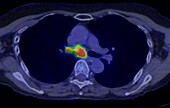 Non-Hodgkin lymphoma, CT-PET scan