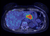Non-Hodgkin lymphoma, CT-PET scan